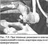Front Anti-Roll Bar — Removal and Installation