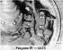 Removal and installation brake calipers and rear brake discs